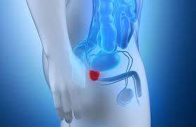 cáncer de próstata metástasis más frecuentes diferenta dintre urinal si uractiv