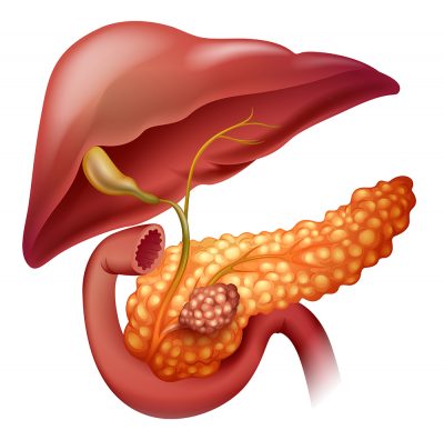 Cáncer de páncreas: diagnóstico, síntomas y tratamiento